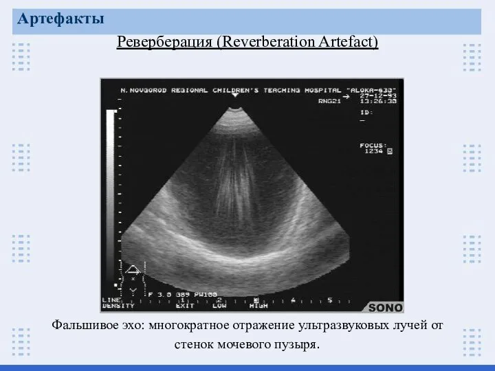 Реверберация (Reverberation Artefact) Артефакты