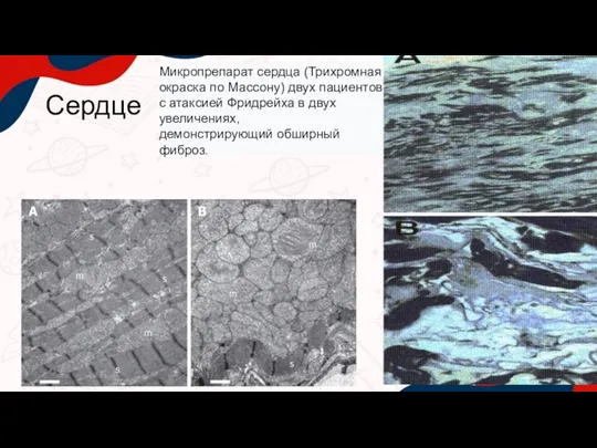 Сердце Микропрепарат сердца (Трихромная окраска по Массону) двух пациентов с атаксией