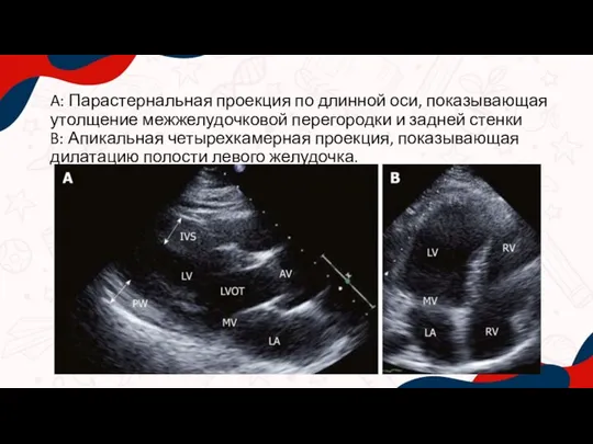 A: Парастернальная проекция по длинной оси, показывающая утолщение межжелудочковой перегородки и