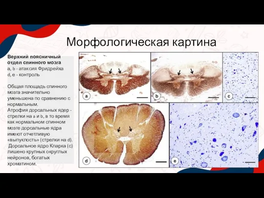 Морфологическая картина Верхний поясничный отдел спинного мозга а, b - атаксия