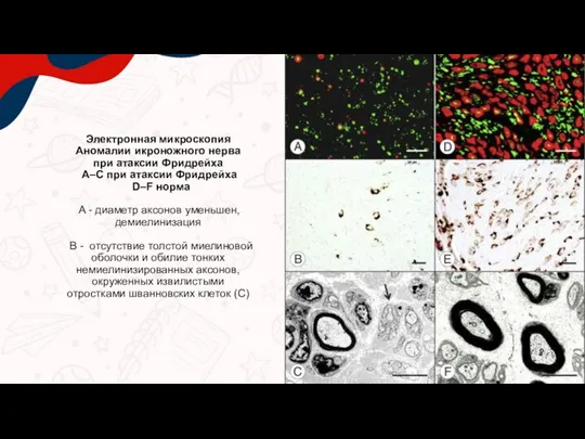 Электронная микроскопия Аномалии икроножного нерва при атаксии Фридрейха A–C при атаксии