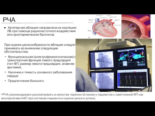 РЧА Катетерная аблация направлена на изоляцию ЛВ при помощи радиочастотного воздействия