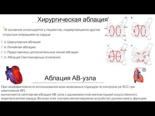 Хирургическая аблация A: Циркулярная аблация B: Линейная аблация. C: Представлены дополнительные