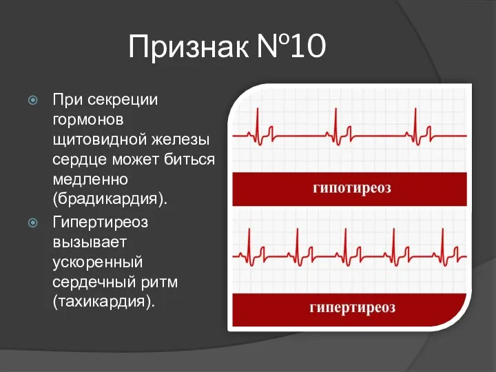 Признак №10 При секреции гормонов щитовидной железы сердце может биться медленно