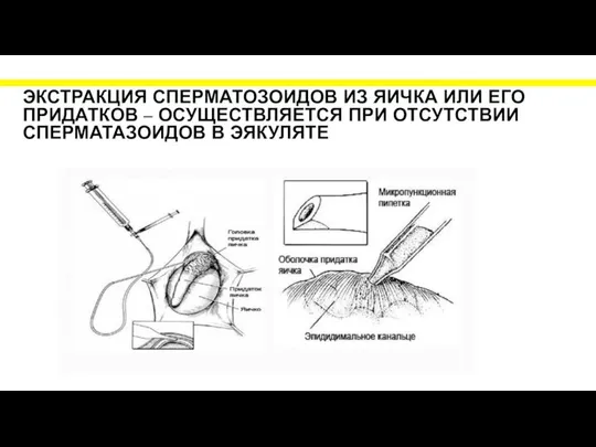 ЭКСТРАКЦИЯ СПЕРМАТОЗОИДОВ ИЗ ЯИЧКА ИЛИ ЕГО ПРИДАТКОВ – ОСУЩЕСТВЛЯЕТСЯ ПРИ ОТСУТСТВИИ СПЕРМАТАЗОИДОВ В ЭЯКУЛЯТЕ