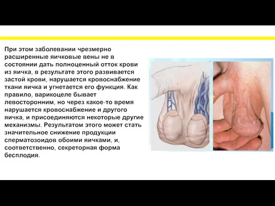 При этом заболевании чрезмерно расширенные яичковые вены не в состоянии дать