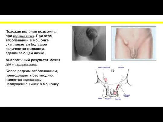 Похожие явления возможны при водянке яичка. При этом заболевании в мошонке