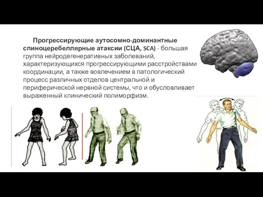 Прогрессирующие аутосомно-доминантные спиноцеребеллярные атаксии (СЦА, SCA) - большая группа нейродегенеративных заболеваний,