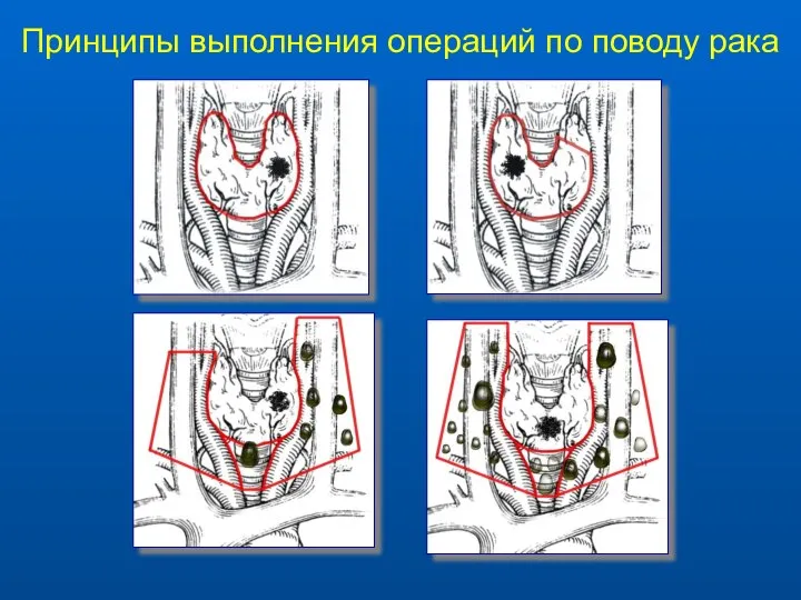 Принципы выполнения операций по поводу рака