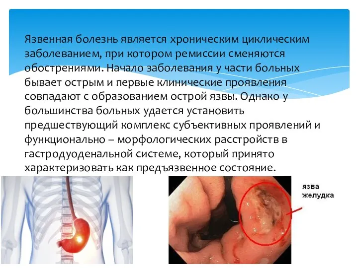 Язвенная болезнь является хроническим циклическим заболеванием, при котором ремиссии сменяются обострениями.