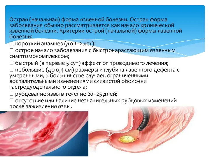 Острая (начальная) форма язвенной болезни. Острая форма заболевания обычно рассматривается как