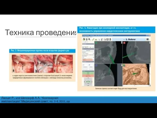 Техника проведения Ласциг Р., and Шендорф А.А. "Кохлеарная имплантация" Медицинский совет, no. 3-4, 2011, pp. 15-18.