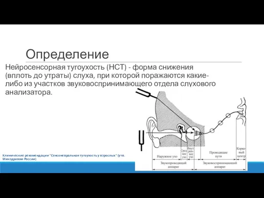 Определение Нейросенсорная тугоухость (НСТ) - форма снижения (вплоть до утраты) слуха,