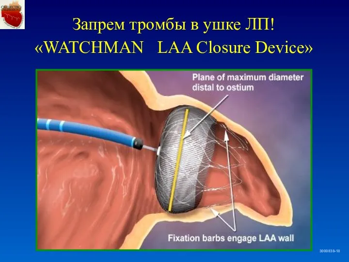 Запрем тромбы в ушке ЛП! «WATCHMAN LAA Closure Device» 3000838-18