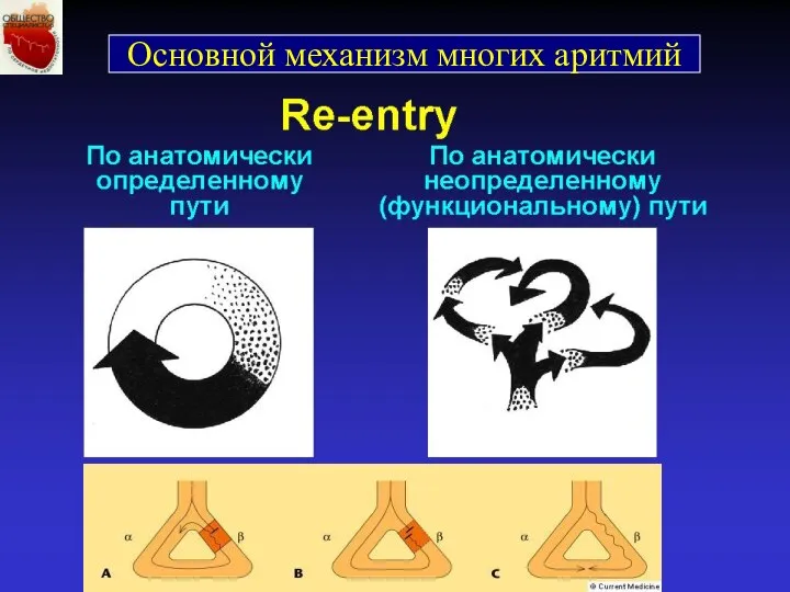 Основной механизм многих аритмий