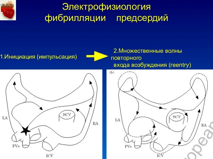 Инициация (импульсация) 2.Множественные волны повторного входа возбуждения (reentry) Электрофизиология фибрилляции предсердий