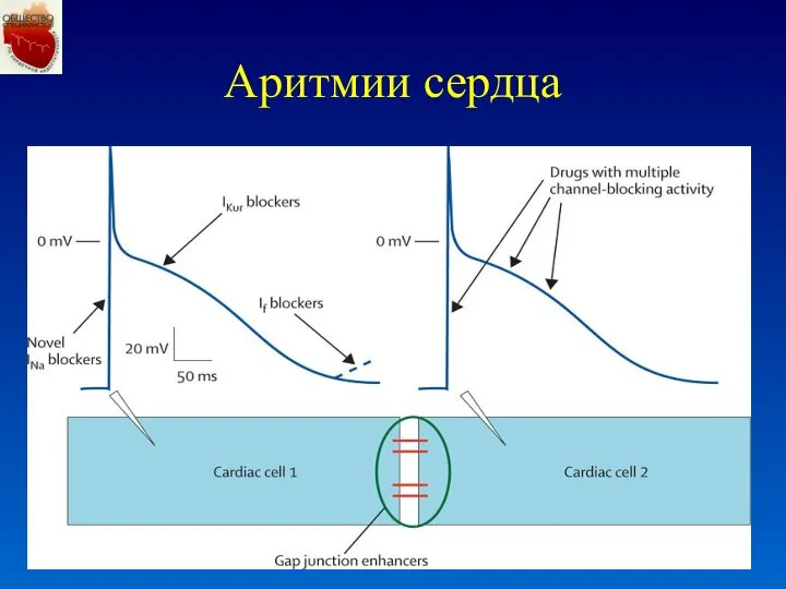 Аритмии сердца