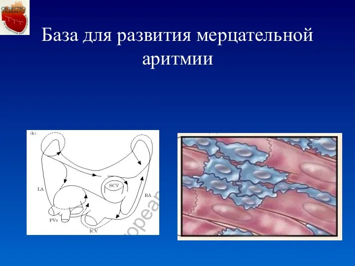 База для развития мерцательной аритмии