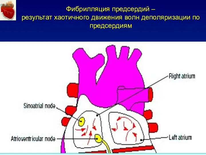 Фибрилляция предсердий – результат хаотичного движения волн деполяризации по предсердиям
