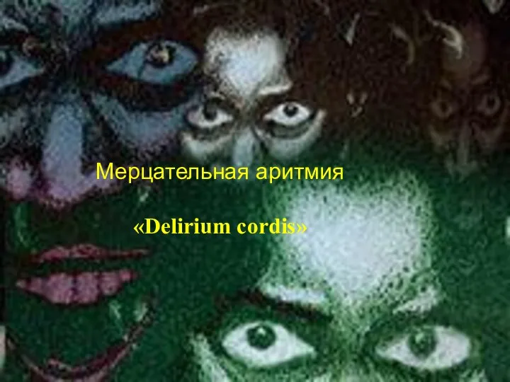 Мерцательная аритмия «Delirium cordis»