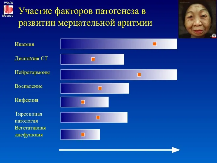 Участие факторов патогенеза в развитии мерцательной аритмии Ишемия Дисплазия СТ Нейрогормоны