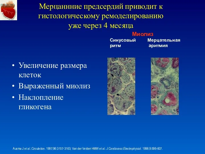 Миолиз Синусовый ритм Мерцательная аритмия Ausma J et al. Circulation. 1997;96:3157-3163;