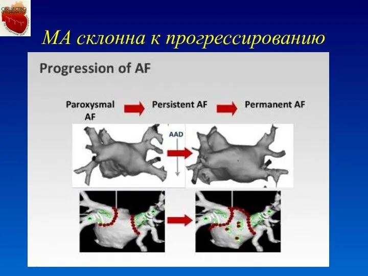 МА склонна к прогрессированию