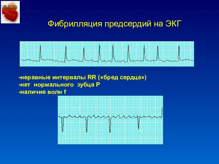 Фибрилляция предсердий на ЭКГ -неравные интервалы RR («бред сердца») -нет нормального зубца P -наличие волн f