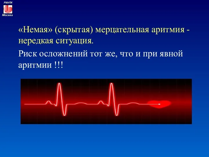 «Немая» (скрытая) мерцательная аритмия - нередкая ситуация. Риск осложнений тот же,