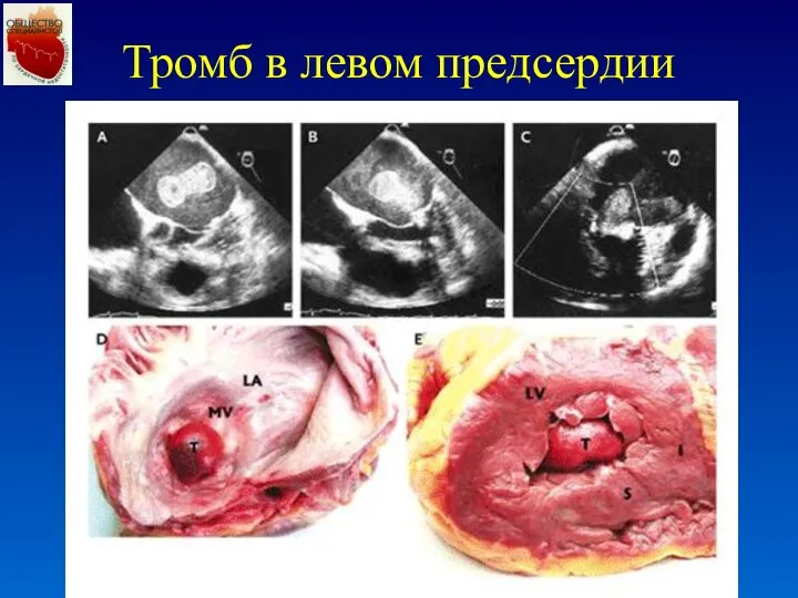 Тромб в левом предсердии