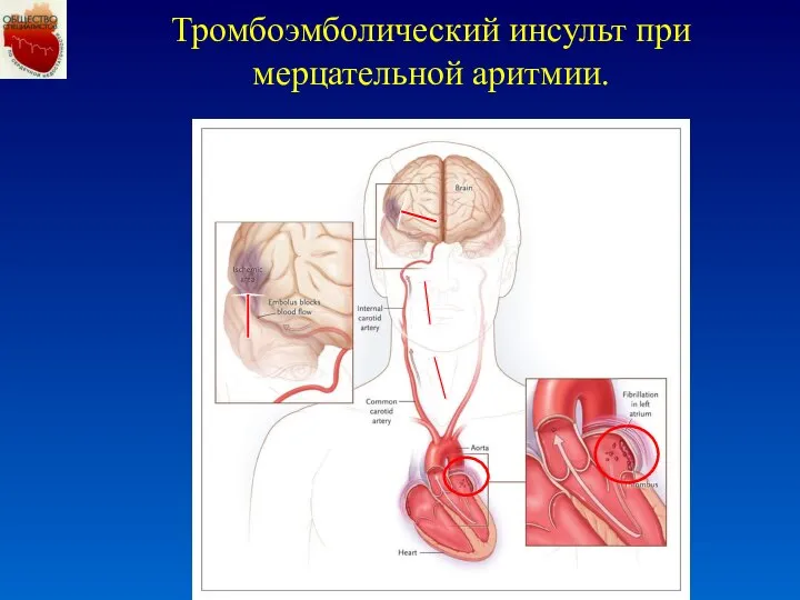 Тромбоэмболический инсульт при мерцательной аритмии.