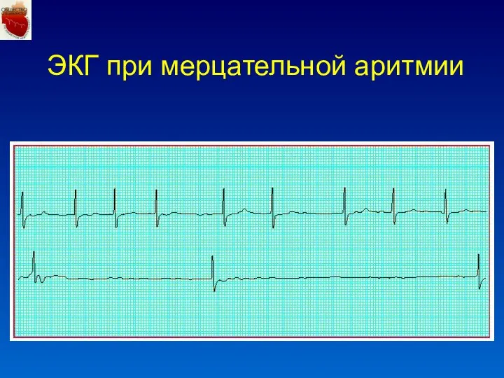 ЭКГ при мерцательной аритмии