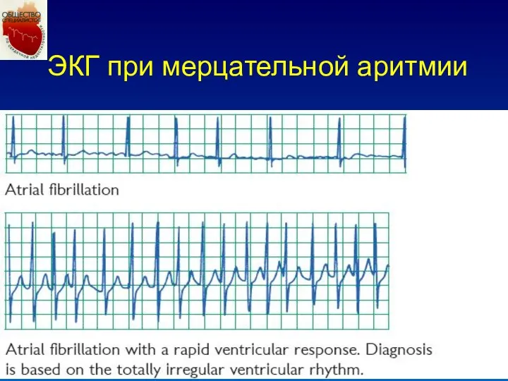 ЭКГ при мерцательной аритмии