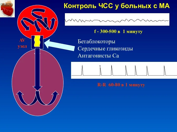 R-R 60-80 в 1 минуту f - 300-500 в 1 минуту
