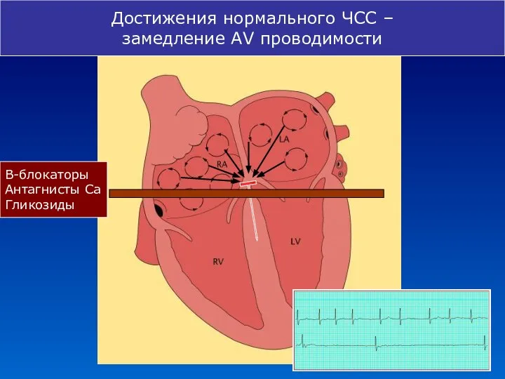 В-блокаторы Антагнисты Са Гликозиды Достижения нормального ЧСС – замедление AV проводимости