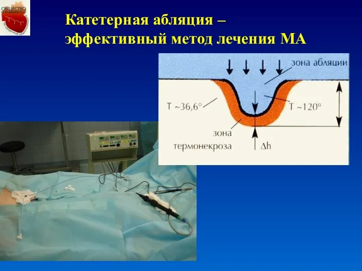 Катетерная абляция – эффективный метод лечения МА