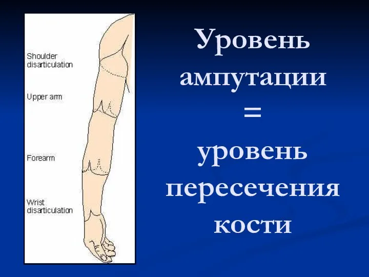 Уровень ампутации = уровень пересечения кости