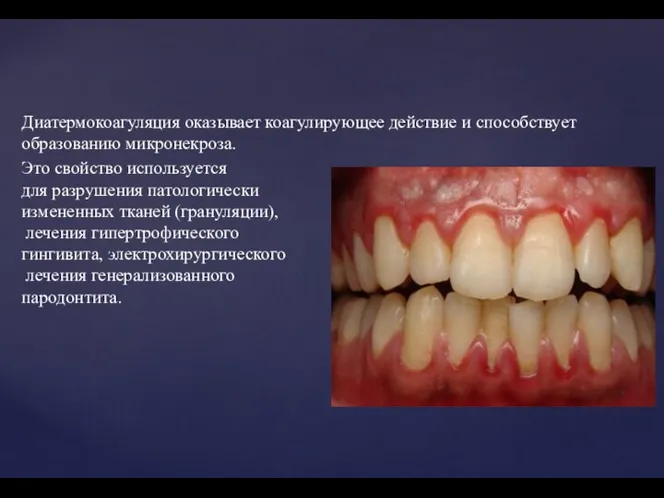 Диатермокоагуляция оказывает коагулирующее действие и способствует образованию микронекроза. Это свойство используется