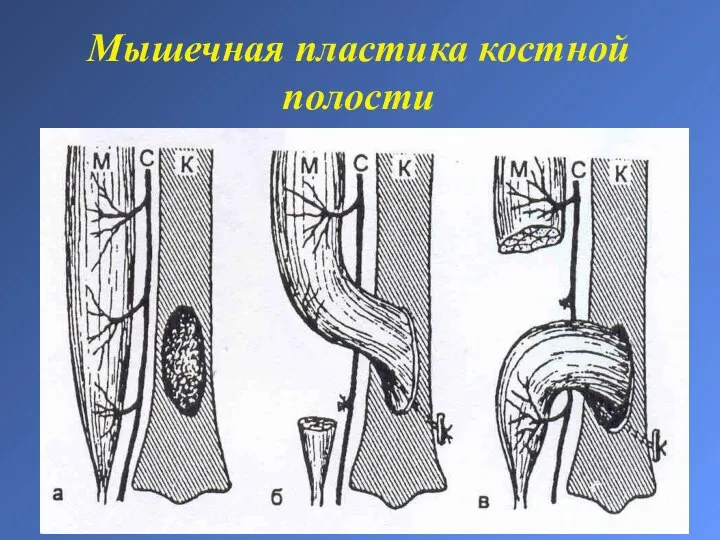 Мышечная пластика костной полости