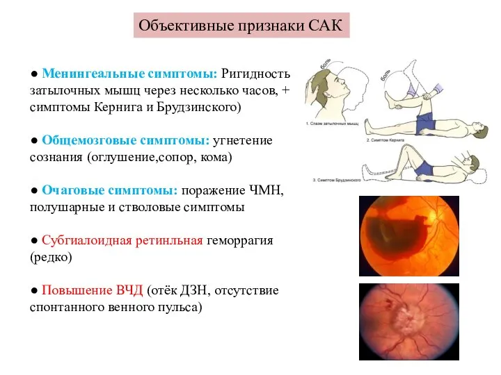 Объективные признаки САК ● Менингеальные симптомы: Ригидность затылочных мышц через несколько