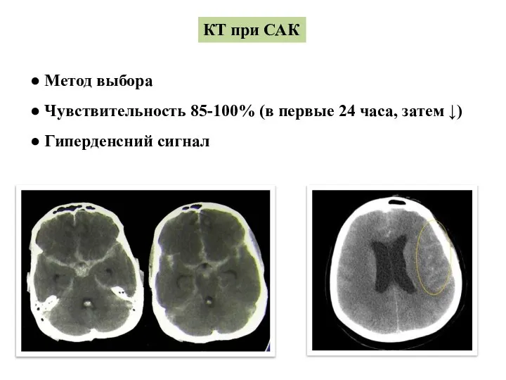 КТ при САК ● Метод выбора ● Чувствительность 85-100% (в первые