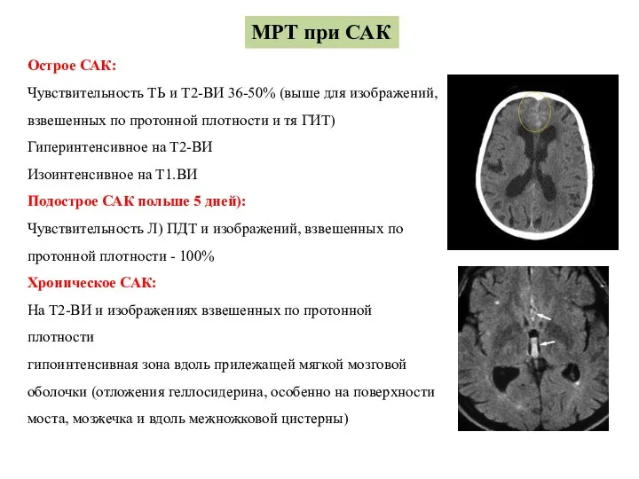 МРТ при САК Острое САК: Чувствительность ТЬ и Т2-ВИ 36-50% (выше