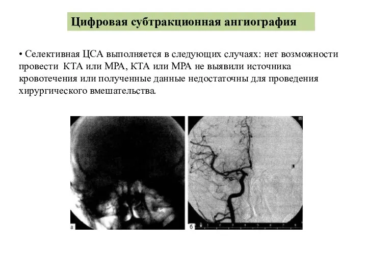 Цифровая субтракционная ангиография • Селективная ЦСА выполняется в следующих случаях: нет