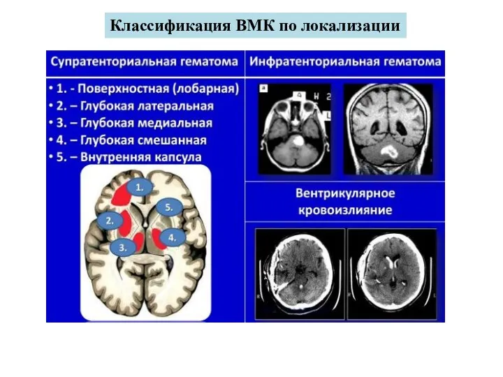 Классификация ВМК по локализации