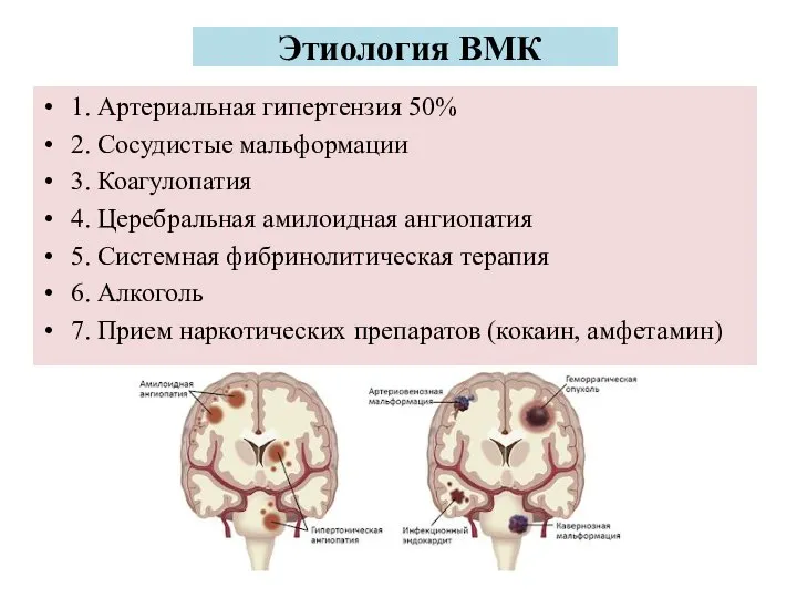 Этиология ВМК 1. Артериальная гипертензия 50% 2. Сосудистые мальформации 3. Коагулопатия