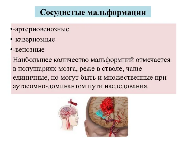 Сосудистые мальформации -артериовенозные -кавернозные -венозные Наибольшее количество мальформций отмечается в полушариях