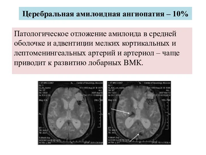 Церебральная амилоидная ангиопатия – 10% Патологическое отложение амилоида в средней оболочке