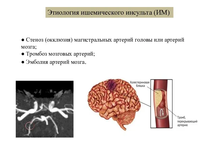 Этиология ишемического инсульта (ИМ) ● Стеноз (окклюзия) магистральных артерий головы или