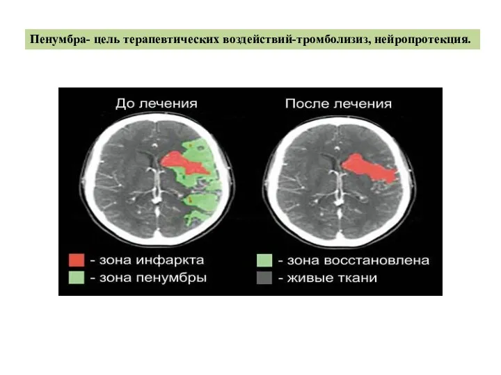 Пенумбра- цель терапевтических воздействий-тромболизиз, нейропротекция.