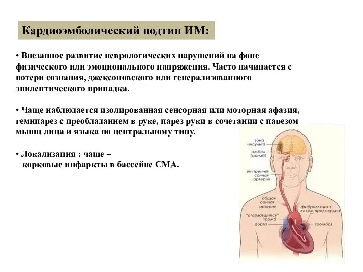 Кардиоэмболический подтип ИМ: • Внезапное развитие неврологических нарушений на фоне физического